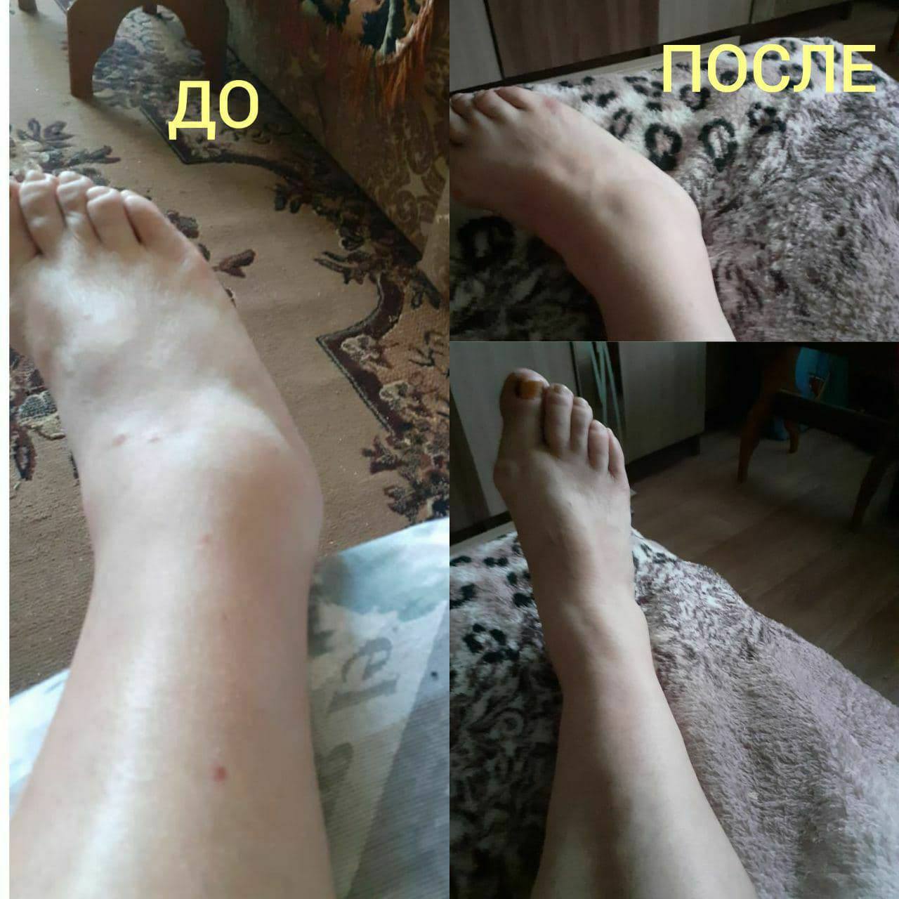 История: За 5 месяцев прошли отёки на ногах, минус 9 кг